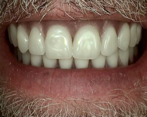 close up of patients mouth after denture procedure