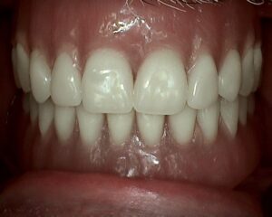 close up of patients mouth after denture procedure