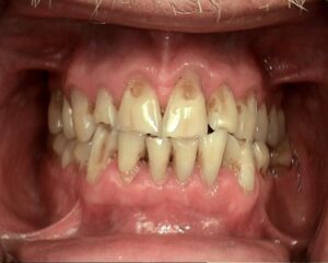 close up of dental patients mouth displaying tartar build up, bone loss, crowding and grinding