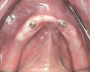 close up of inside the patients mouth showing the new implants the dentures clip on to.