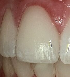 Close up of the completed work of adding a new porcelain crown to fix a tooth fracture