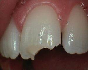 Close up of front tooth fracture