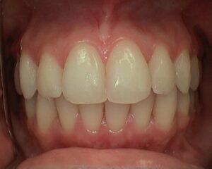 Close up of teeth revealing the straightening and corrective affects of invisalign