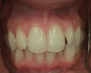 Close up of crooked and crowded teeth before the invisalign treatment