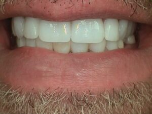 Close up of man smiling with a full mouth restorative treatment done on ziconia to replace old crowns for a whiter and brighter look