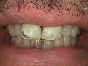 Close up of man smiling with badly damaged teeth