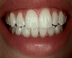 Close up of noticeably whiter and brighter teeth after the phillips zoom treatment