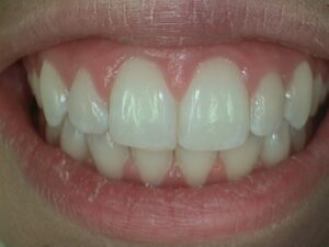 Close up of yellowing teeth