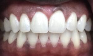 Close up of noticeably whiter and brighter teeth after the phillips zoom treatment