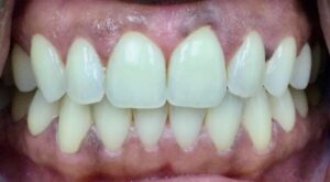 Close up of yellowing teeth