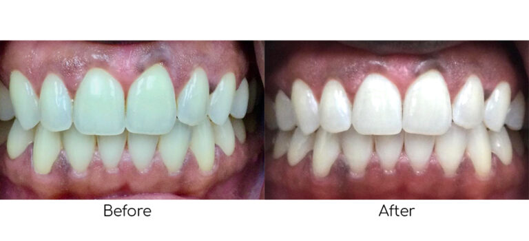 Before-and-after results of Philips Zoom Teeth Whitening, showing a visibly whiter and brighter smile after professional treatment.