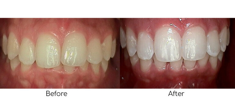 Before-and-after results of Philips Zoom Teeth Whitening, showing a visibly whiter and brighter smile after professional treatment.