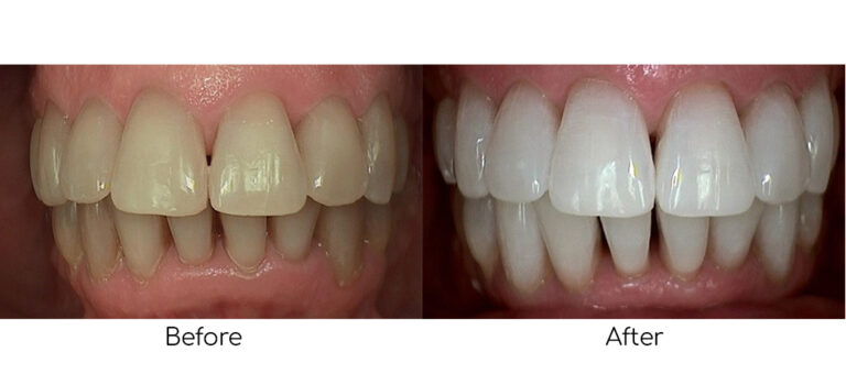 Before-and-after results of Philips Zoom Teeth Whitening, showing a visibly whiter and brighter smile after professional treatment.