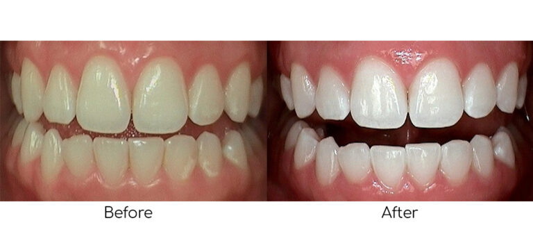 Before-and-after results of Philips Zoom Teeth Whitening, showing a visibly whiter and brighter smile after professional treatment.