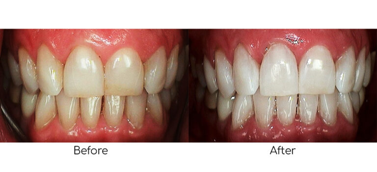 Before-and-after results of Philips Zoom Teeth Whitening, showing a visibly whiter and brighter smile after professional treatment.